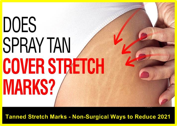 Tanned Stretch Marks
